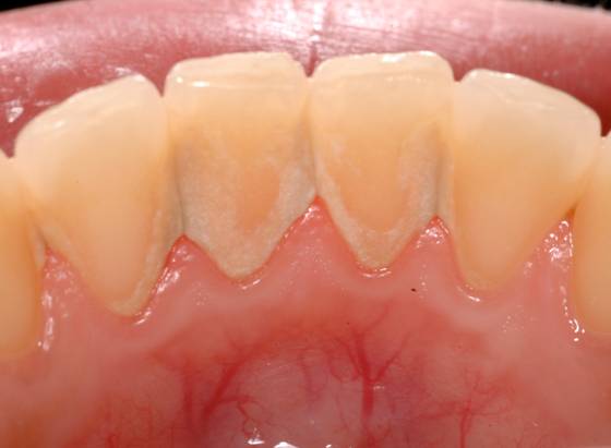 軽度歯周病の治療【歯周病治療】アメリカ歯周病専門医|東京都江戸川区